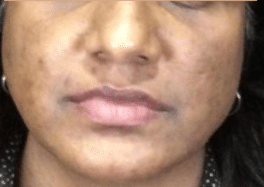 Before Image: Bellafill Acne Treatment with Luma Forte Facial Cream - front