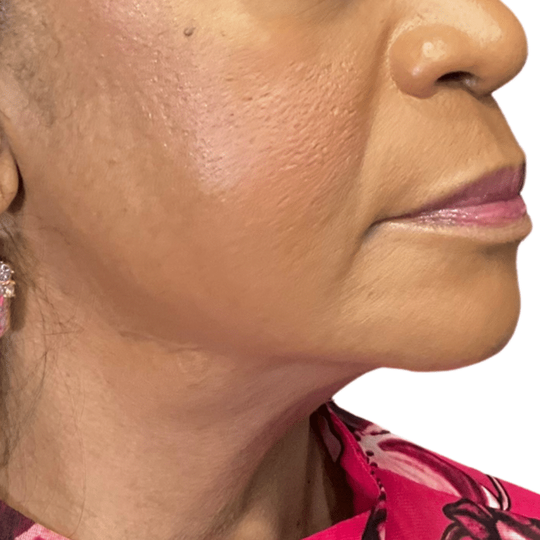 Before Image: Bellafill and VittaPure treatment - right-side