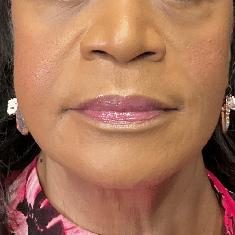 Before Image: Bellafill and VittaPure treatment - front