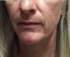 Before Image: Bellafill Cheeks - front