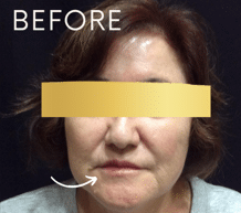Before Image: RHA and Botox Treatments - front