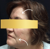 After Image: RHA and Botox Treatments - front