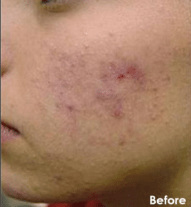 Before Image: Chemical Peel Facial