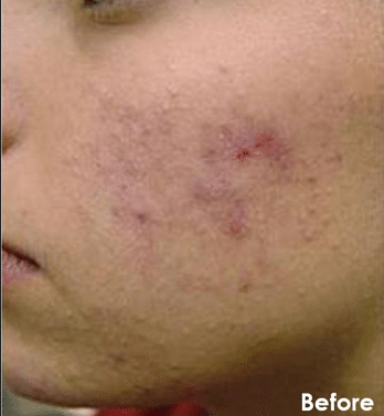 Before Image: Chemical Peel Facial - front