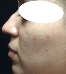 Before Image: Non-surgical Rhinoplasty with Radiesse Filler - front
