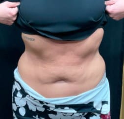 Before Image: Emsculpt Body Toning - front