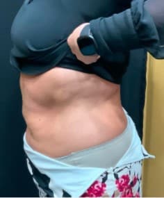 Before Image: Emsculpt Body Toning - left-side