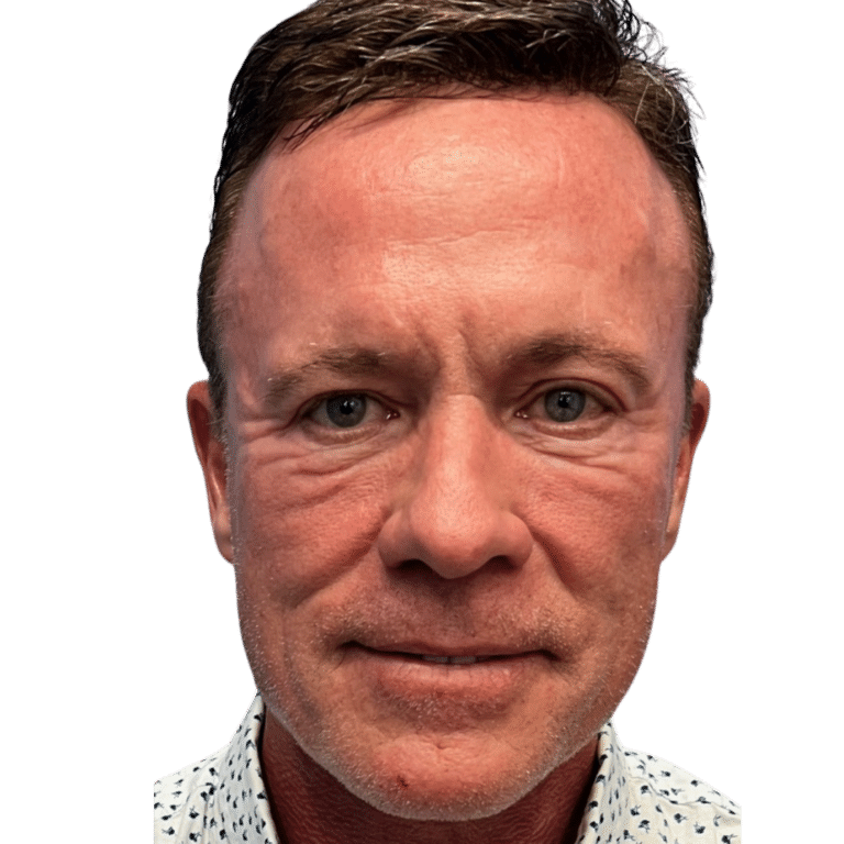Before Image: Bellafill and Thermage FLX face treatment - front