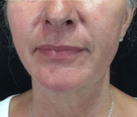 After Image: Bellafill Cheeks - front