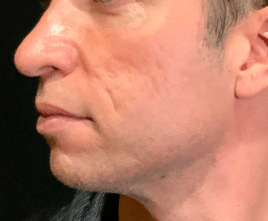 Before Image: Bellafill Acne Scar Treatment - front