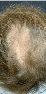 Before Image: Microneedling RF with PRP for Hair Loss