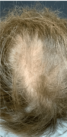 Before Image: Microneedling RF with PRP for Hair Loss - front