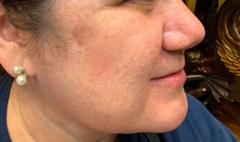 After Image: IPL Facial Brown Spots Lightener - front