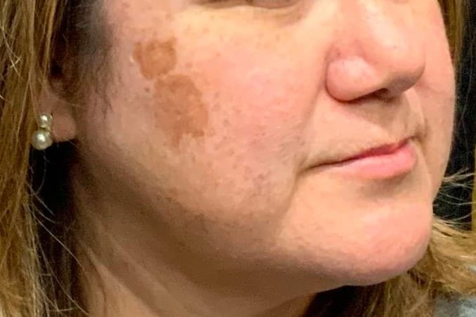 Before Image: IPL Facial Brown Spots Lightener - front