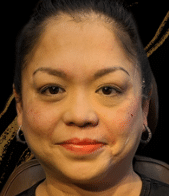 Before Image: Juvederm Ultra Plus Lip Enhancement