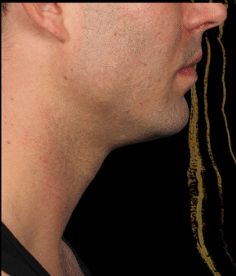 After Image: Kybella Double Chin Reduction Male - front