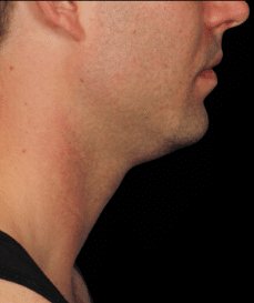 Before Image: Kybella Double Chin Reduction Male - front