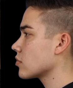 After Image: Kybella Under Chin Reduction Male - front