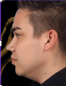 Before Image: Kybella Under Chin Reduction Male - front