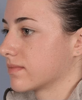 After Image: Microdermabrasion facial - front