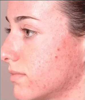 Before Image: Microdermabrasion facial - front
