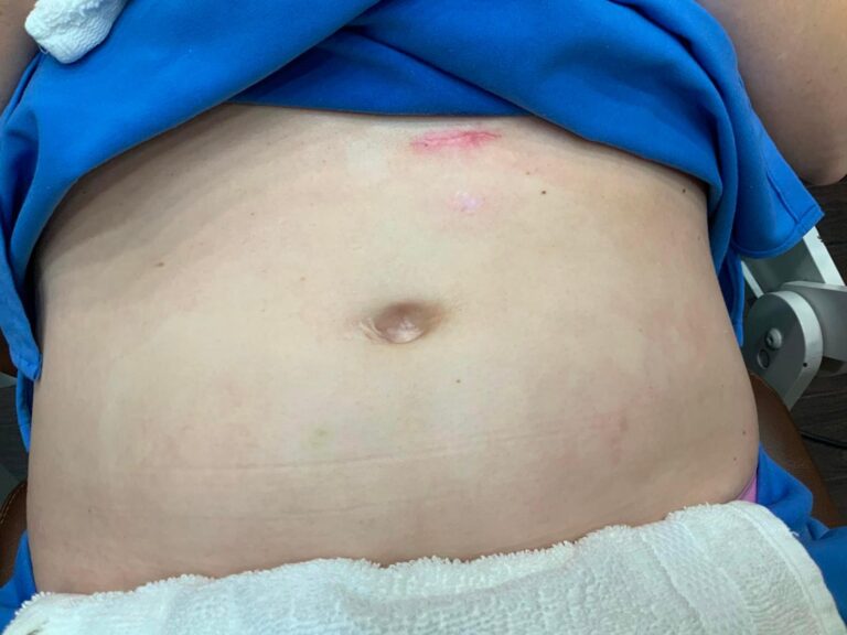 After Image: Fractional Pixel Scar Treatment - front