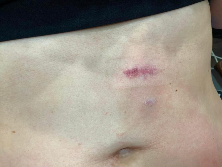 Before Image: Fractional Pixel Scar Treatment - front