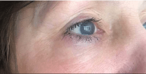 After Image: Plasma IQ Eye Treatment
