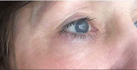 After Image: Plasma IQ Eye Treatment - front