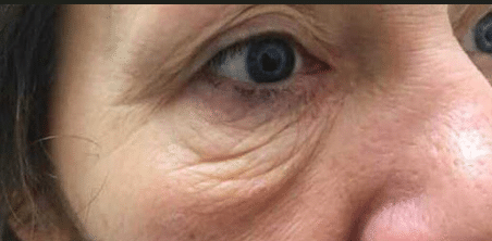 Before Image: Plasma IQ Eye Treatment - front