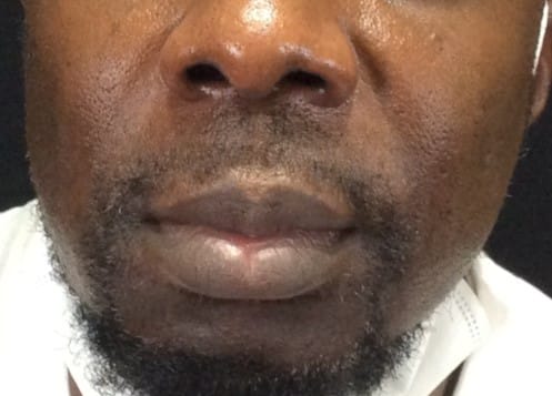After Image: Bellafill for Nasolabial Folds - front