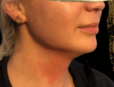 After Image: Chin Definition Procedure with Radiesse - front