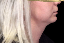 Before Image: Chin Definition Procedure with Radiesse - front
