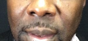 Before Image: Bellafill for Nasolabial Folds