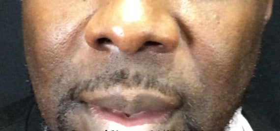 Before Image: Bellafill for Nasolabial Folds - front