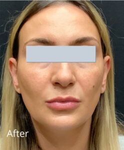 After Image: Juvederm Ultra Plus adding lip volume