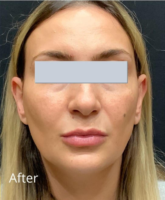After Image: Juvederm Ultra Plus adding lip volume - front