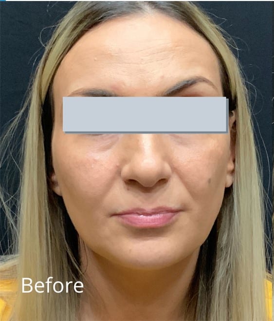 Before Image: Juvederm Ultra Plus adding lip volume - front