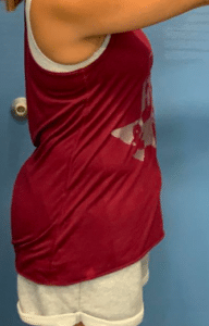 Before Image: Semaglutide Weight Loss Program
