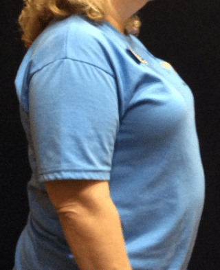 Before Image: Weight Loss Program - front