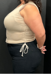 After Image: Semaglutide weight loss 2 months - front