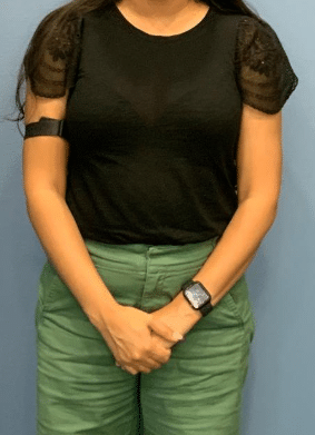 Before Image: Semaglutide Weight Loss Program 3 months - front