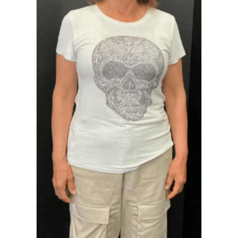 Before Image: Semaglutide after 2 months - front