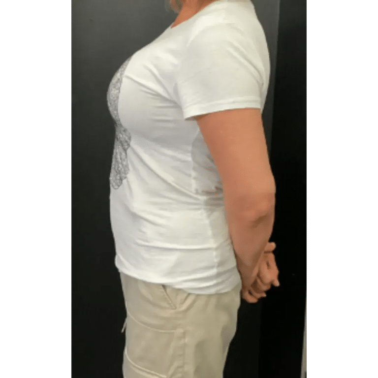 Before Image: Semaglutide after 2 months - left-side