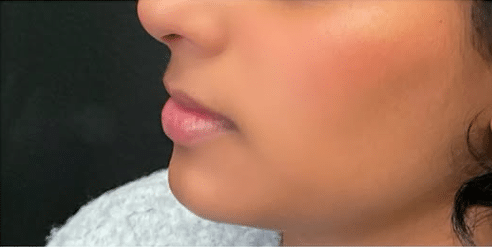 Before Image: Chin defining filler - left-side