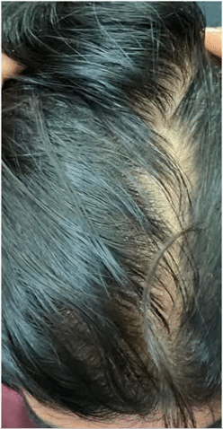 After Image: Hair restoration treatment-Microneedling with PRP - front