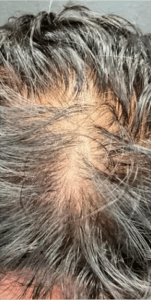 Before Image: Hair restoration treatment-Microneedling with PRP