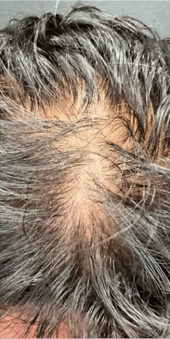 Before Image: Hair restoration treatment-Microneedling with PRP - front