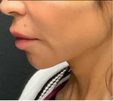 After Image: Jawline filler transformation - left-side