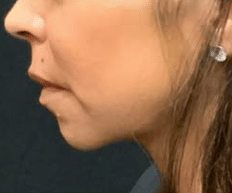 Before Image: Jawline filler transformation - left-side